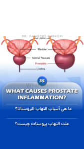 General Information 8 What causes prostate inflammation - Fariborz Bagheri