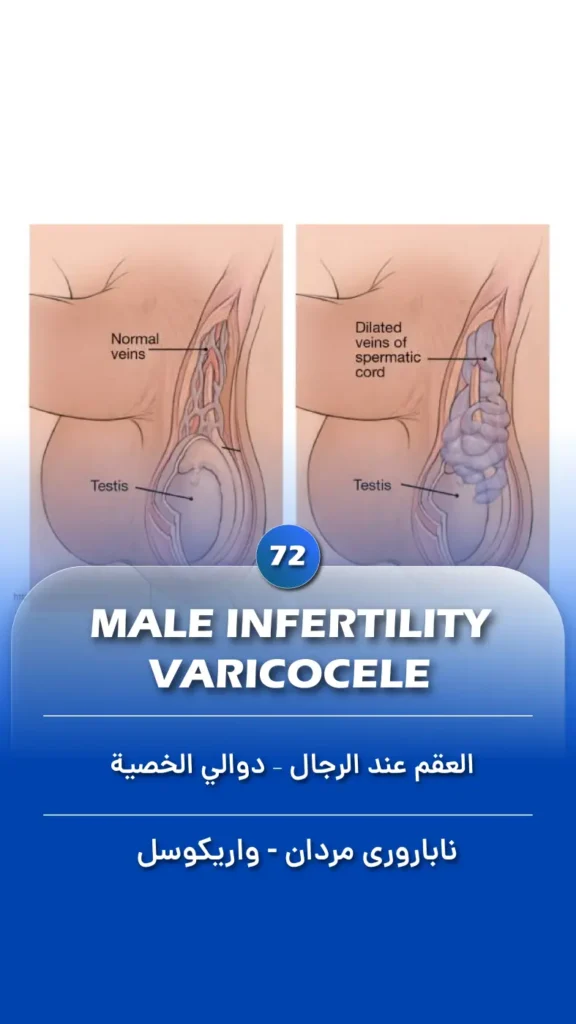 Male Infertility – Varicocele -Fariborz Bagheri