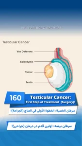 testicular cancer surgery