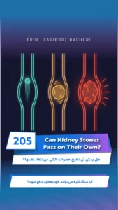 Professor Fariborz Bagheri 21 Kidney Stones Pass on Their Own Through the Ureter
